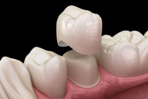 Dental Crowns & Dental Bridges 1 YFD img crown