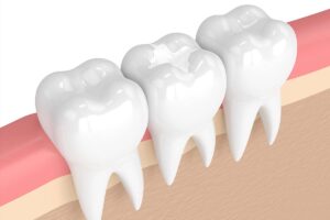 Dental Fillings 1 YFD img dental filling