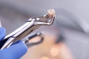 Tooth Extractions 1 YFD img extraction