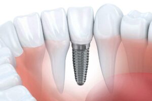Dental Implants 1 Dental Implants - Yamaguchi Family Dentistry - Tumwater Dentist