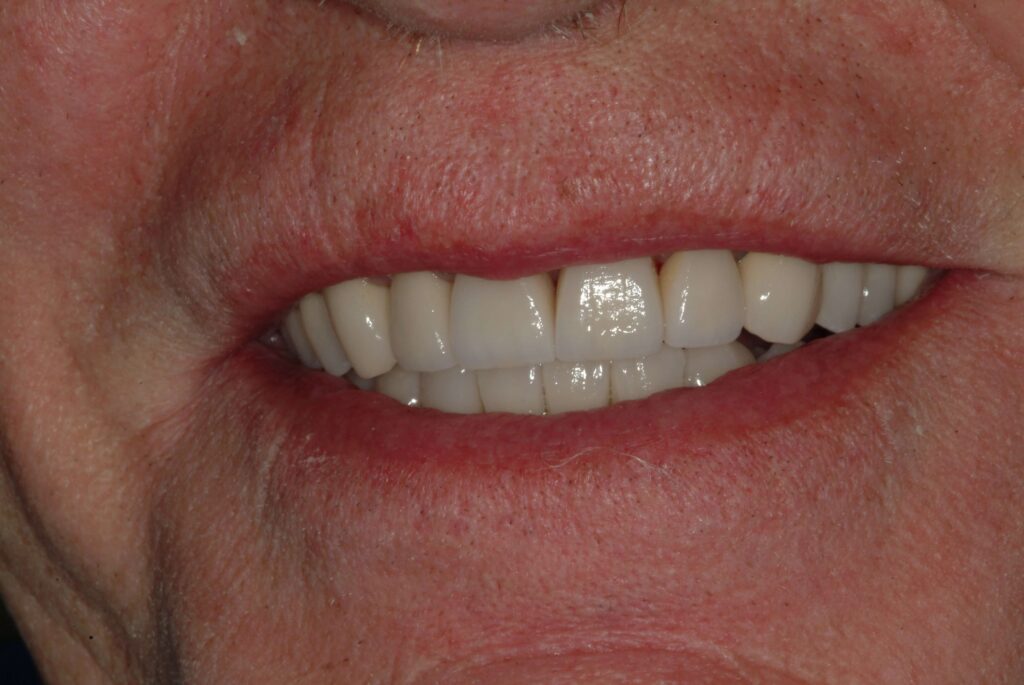 Before & After Gallery 22 11 - After