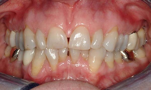 Before & After Gallery 11 6 - Before