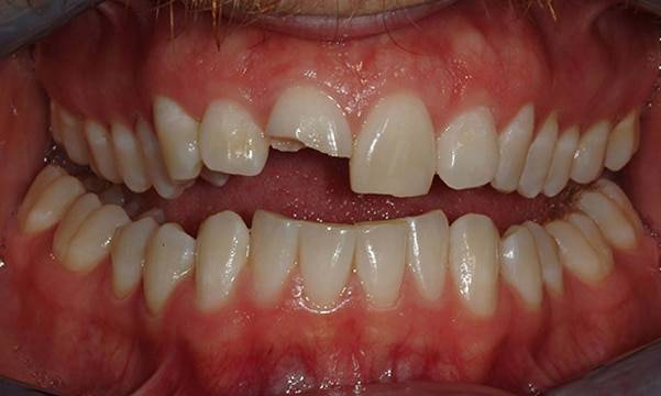 Before & After Gallery 17 9 - Before