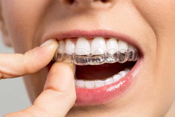 Yamaguchi Family Dentistry - Tumwater Invisalign